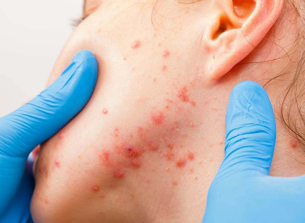 Acne treatments at Glow Dermspa