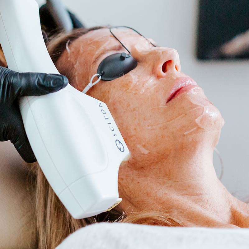 BBL Photofacial Laser Treatment for Skin Health at Med Spa in Lakewood Ranch FL - Glow Dermspa