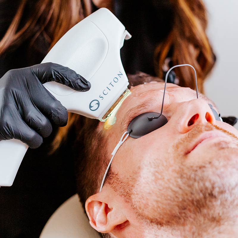 BBL Photofacial Laser Treatments For Skin Health for Men at Glow Dermspa