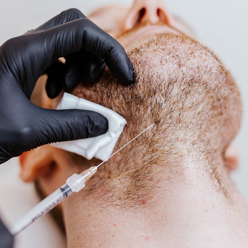 Kybella Injections for Double Chin Removal Treatments for Men at Glow Dermspa in Lakewood Ranch FL