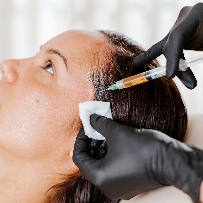 PRF Injections for Hair Restoration and Hair Loss at Glow Dermspa in Lakewood Ranch FL
