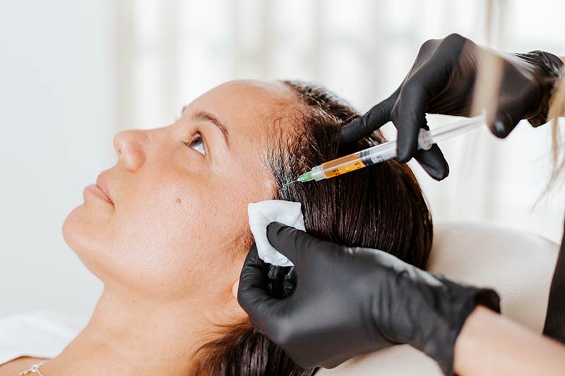 PRF Injections for Hair Restoration and Hair Regrowth During Alopecia Treatment at Glow Dermspa in Florida