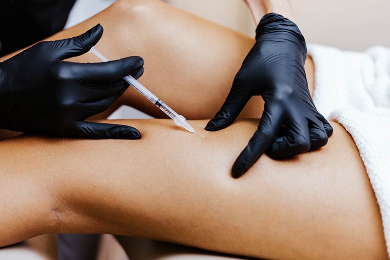 Sclerotherapy Injections during a Spider Vein Treatment on the Legs at Glow Dermspa in Lakewood Ranch FL