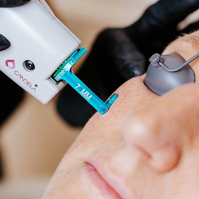 Laser Treatments for Wrinkles Spider Veins Brown Spots Scars Laser Treatments for Wrinkles Spider Veins Brown Spots Scars