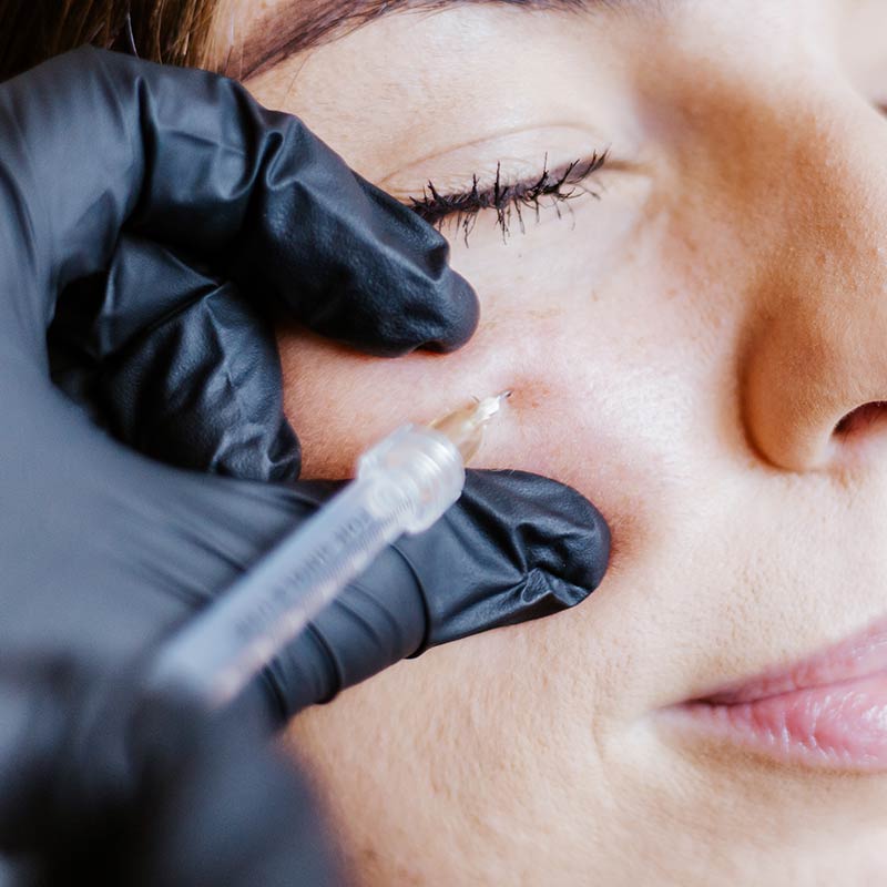PRF Injections for Under Eye Rejuvenation for Tear Troughs in Lakewood Ranch FL