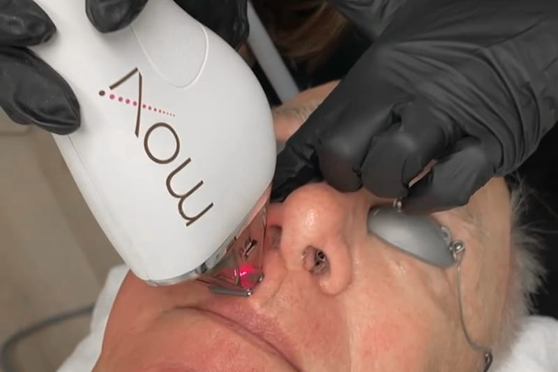 Moxi Laser Treatments at Glow Dermspa in Lakewood Ranch Florida