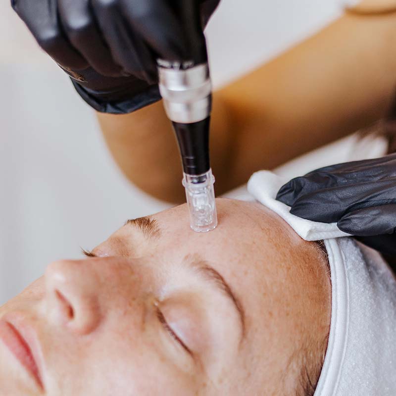 microneedling treatment for skin rejuvenation at Glow Dermspa in Lakewood Ranch