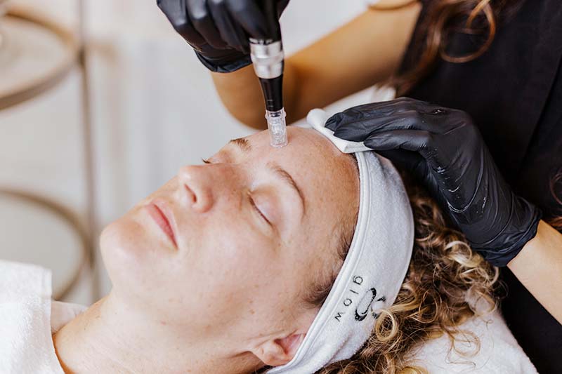 microneedling treatment for skin rejuvenation at Glow Dermspa in Lakewood Ranch