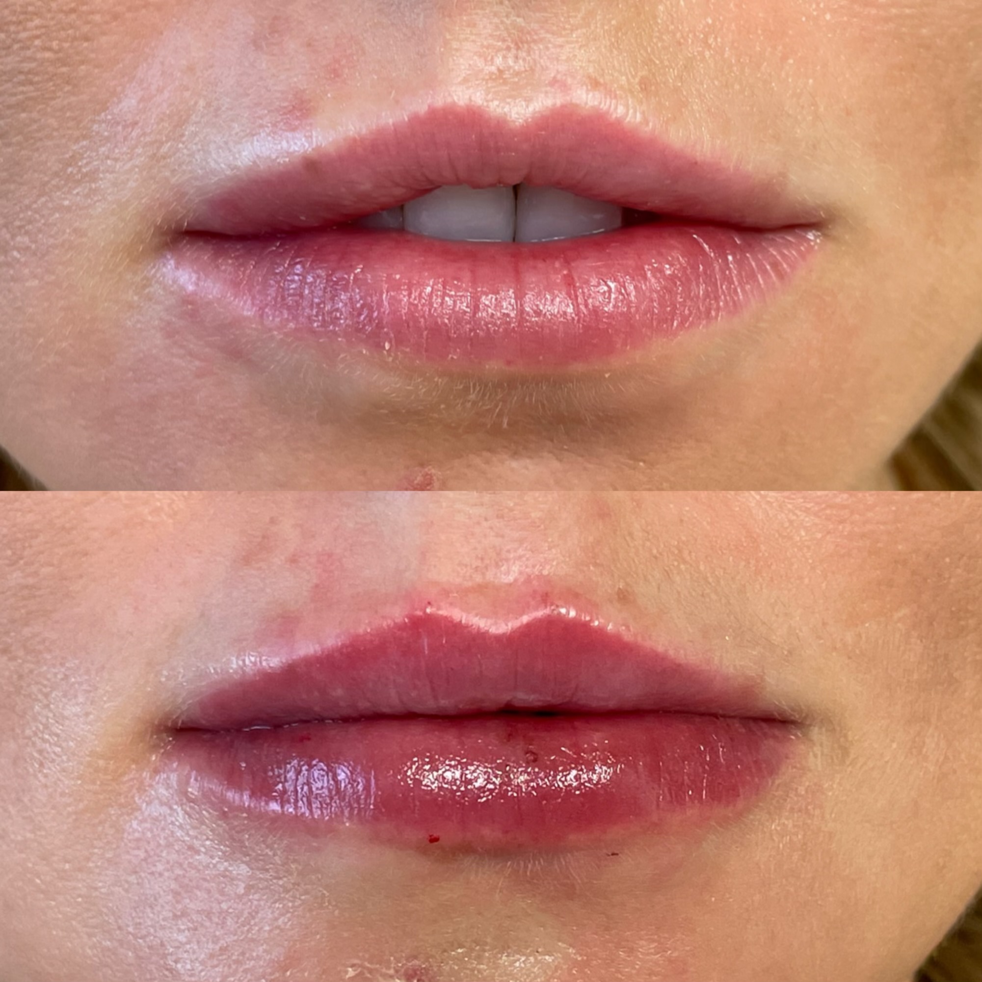 Lip Filler Example with Subtle Volume 2