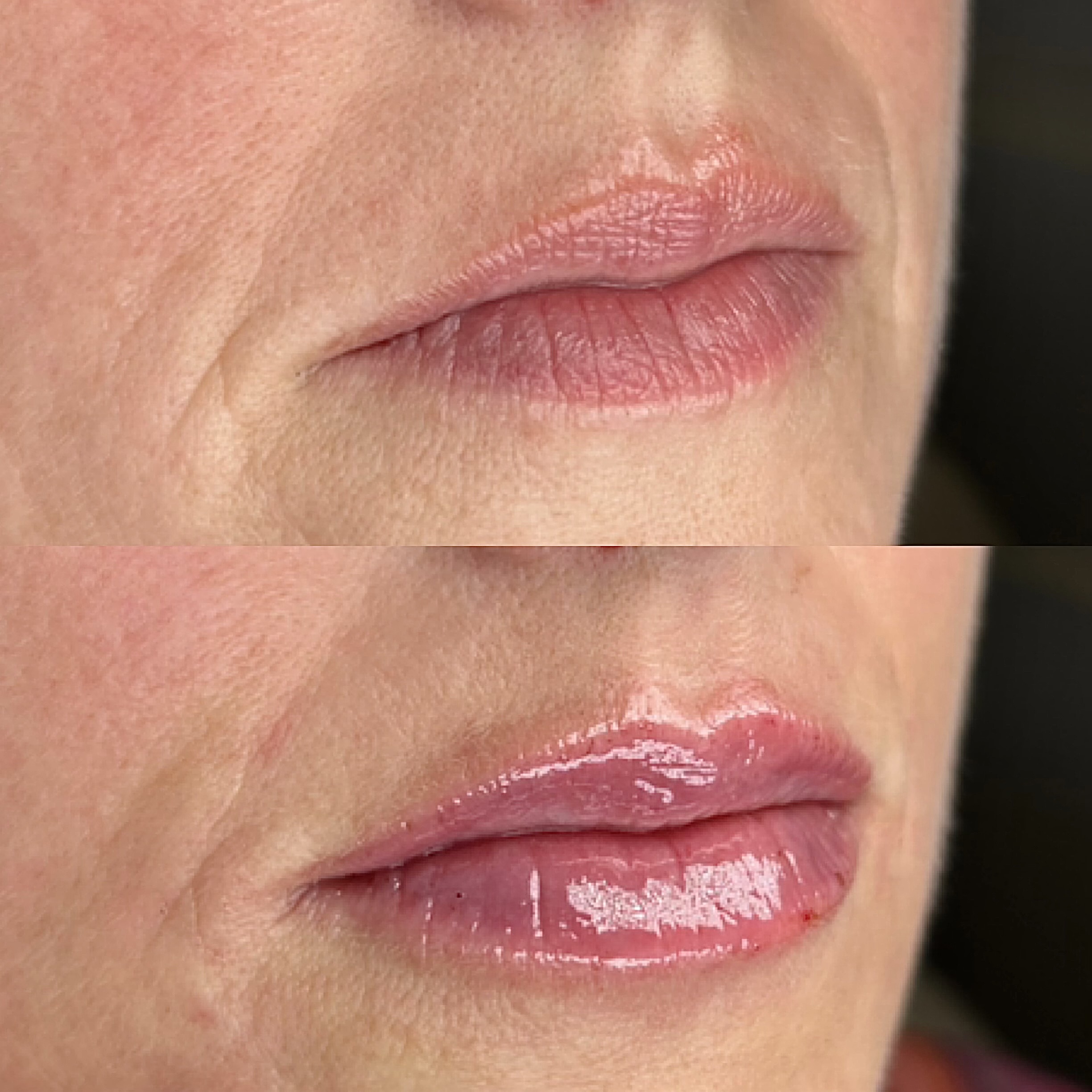 Lip Filler Before & After with Subtle Volume