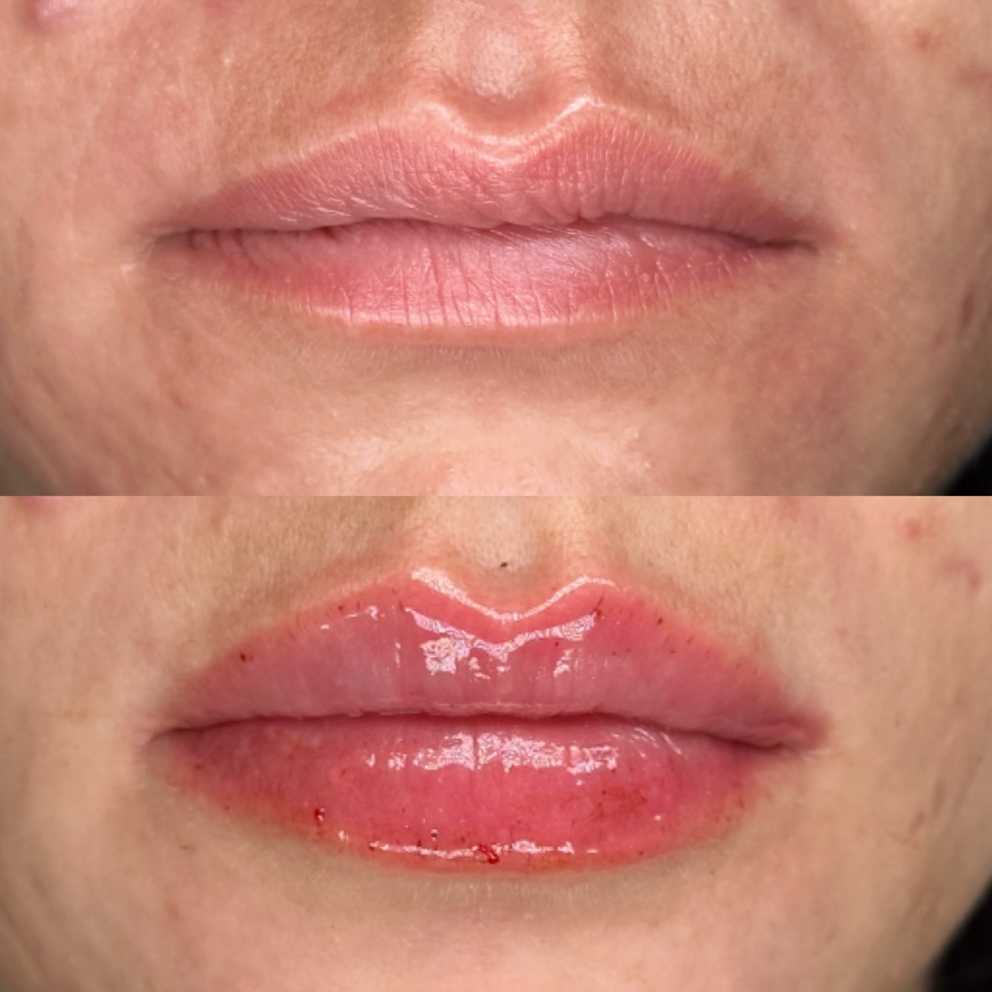 Lip Filler Before and After Example of Big Plump Lips