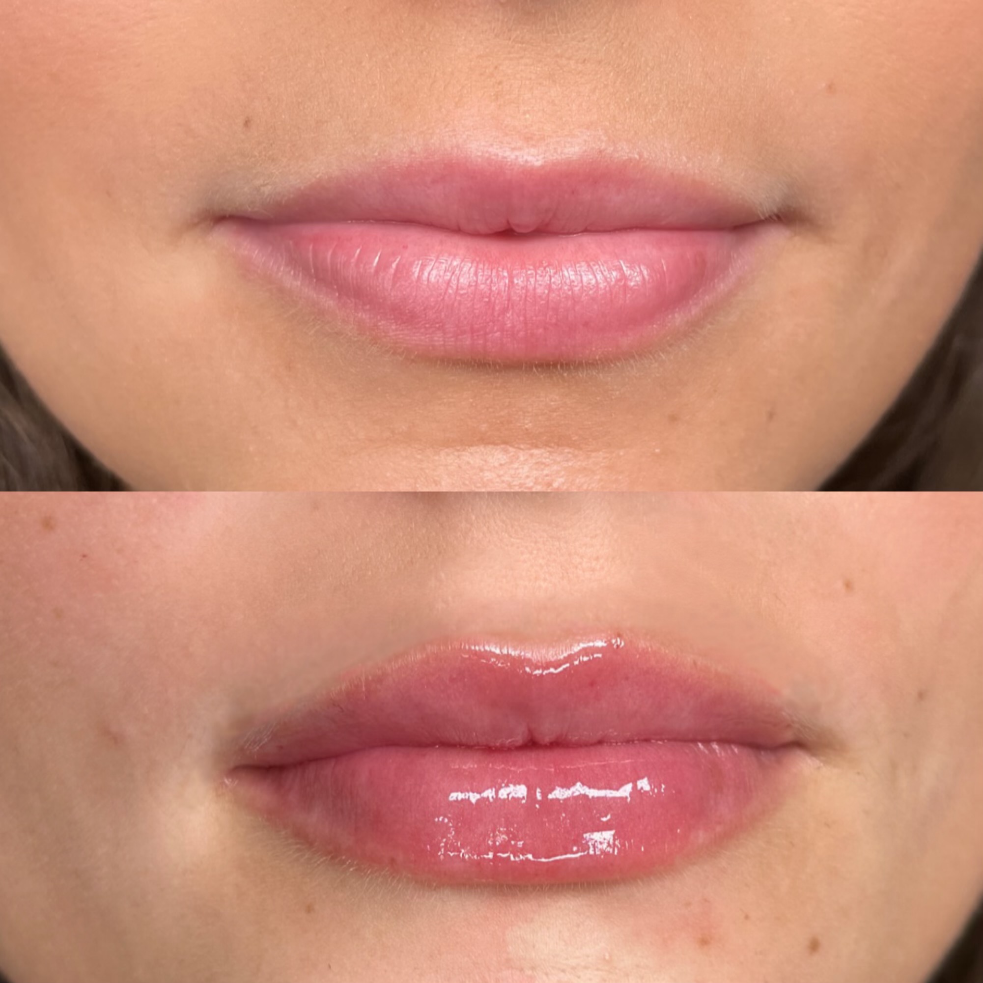 Lip Filler Before & After with Medium Volume