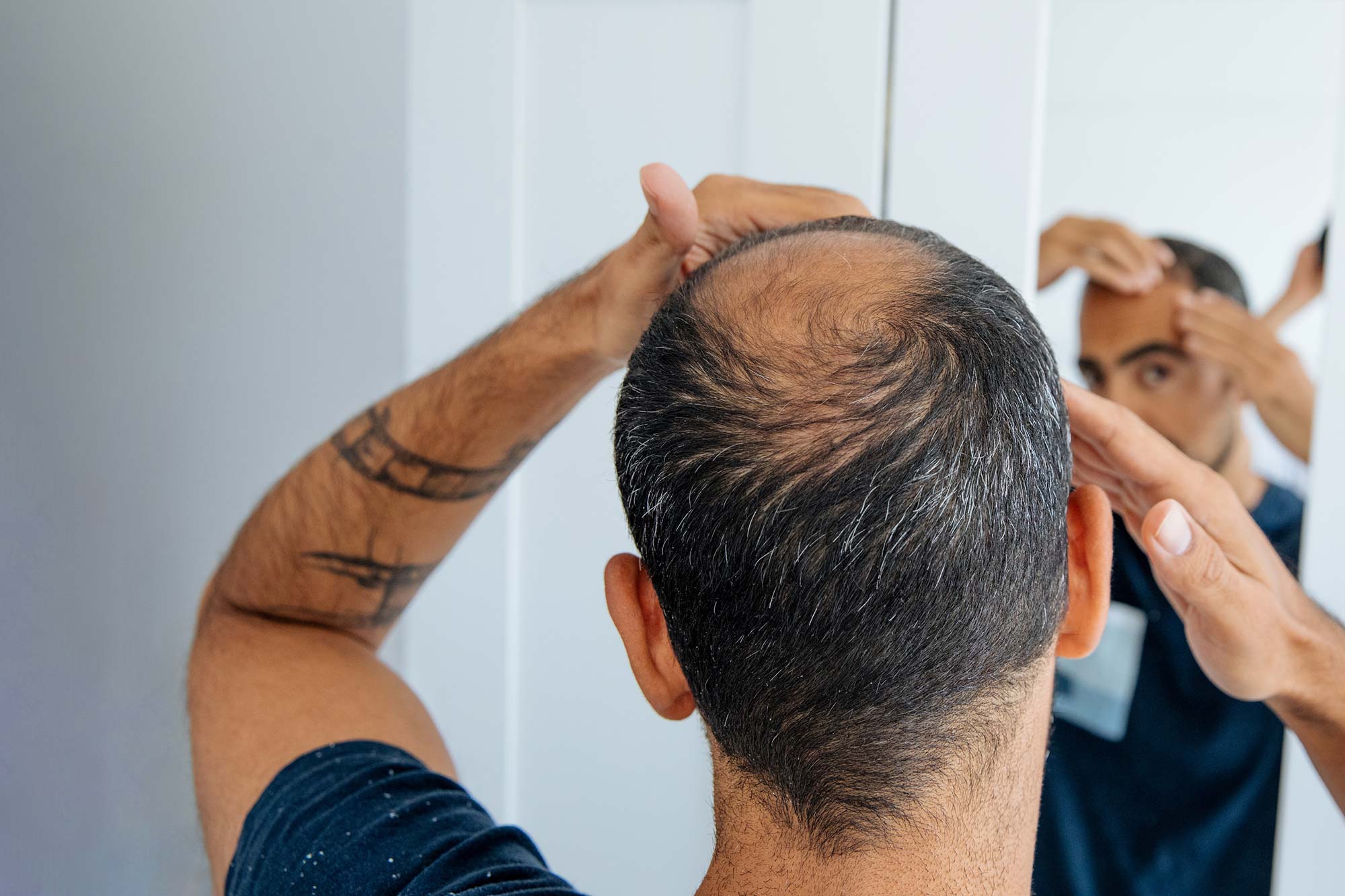 Hair Thinning in Lakewood Ranch FL
