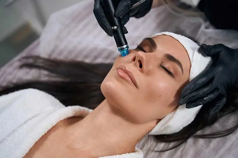 Microneedling with PDGF+ in Lakewood Ranch FL